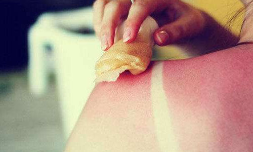 Sunburn treatment